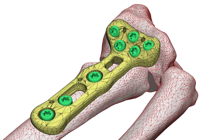 Tailor Surgery - una cirugía personalizada y cómo se planifica