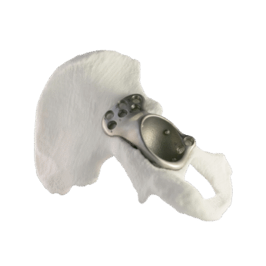 TAILOR SURGERY - Estudio digital 3D de CADERA